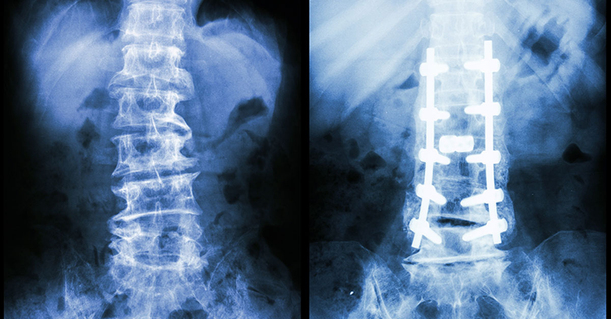 Lumbar Pedicle Screw Fixation - Seattle, WA - Brain and Spine Surgery